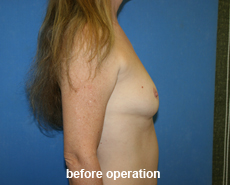 plastic-surgery-breast-augmentation